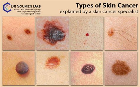 skin cancer near las vegas